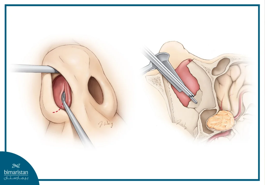 How To Remove A Pituitary Tumor Using An Endoscope Inserted Through The Nose