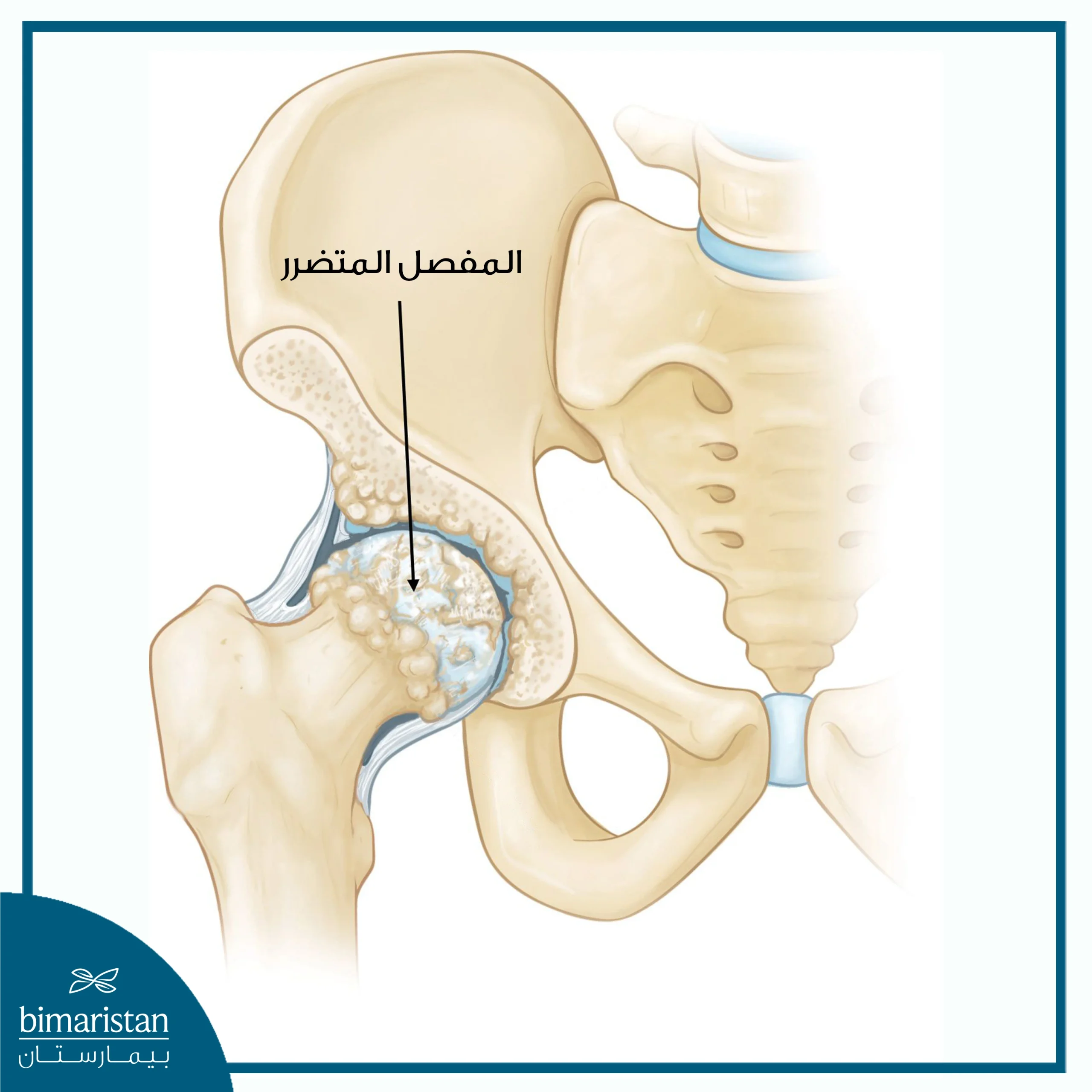 مفصل متضرر يتطلب علاج التهاب مفصل الورك