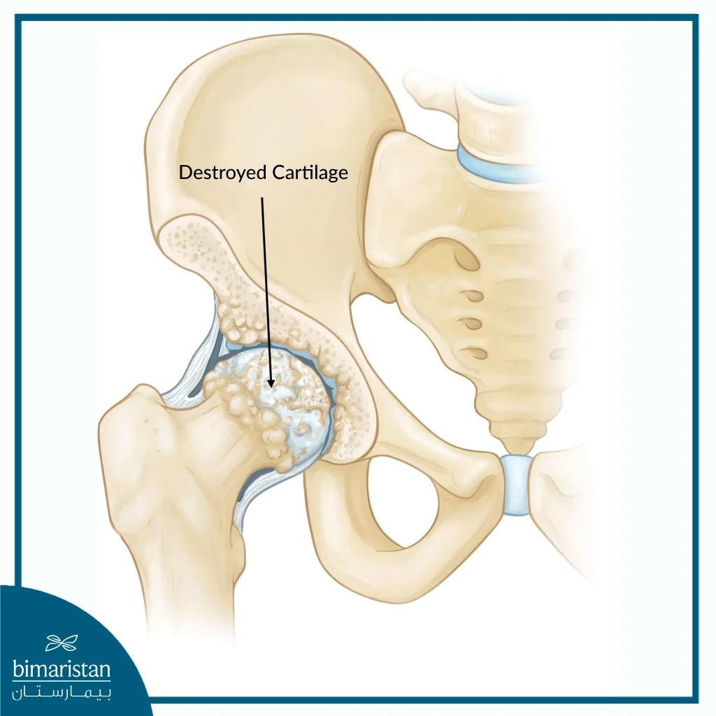 Damaged Joint Requiring Hip Arthritis Treatment