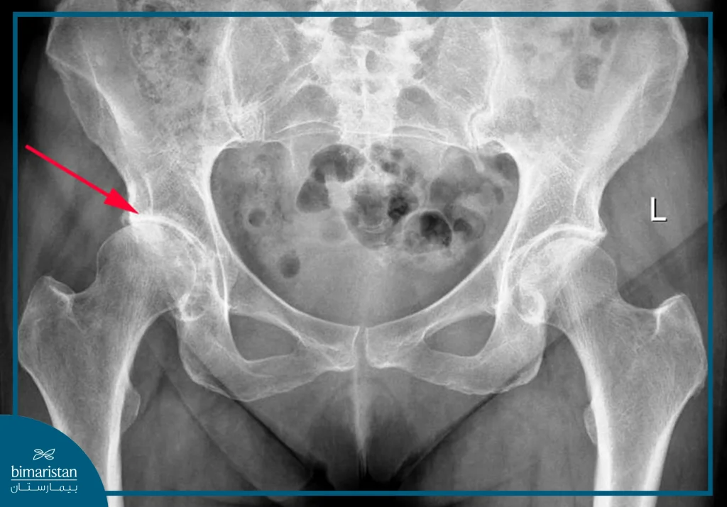 X-Ray Of Hip Arthritis