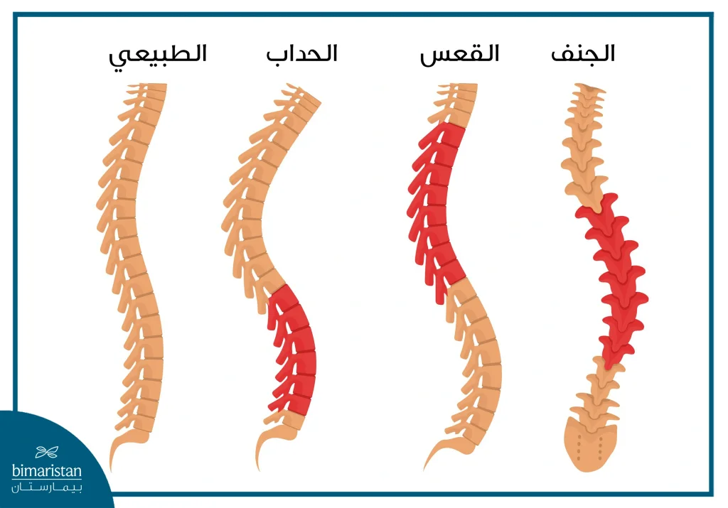 الفرق بين تشوهات العمود الفقري المختلفة