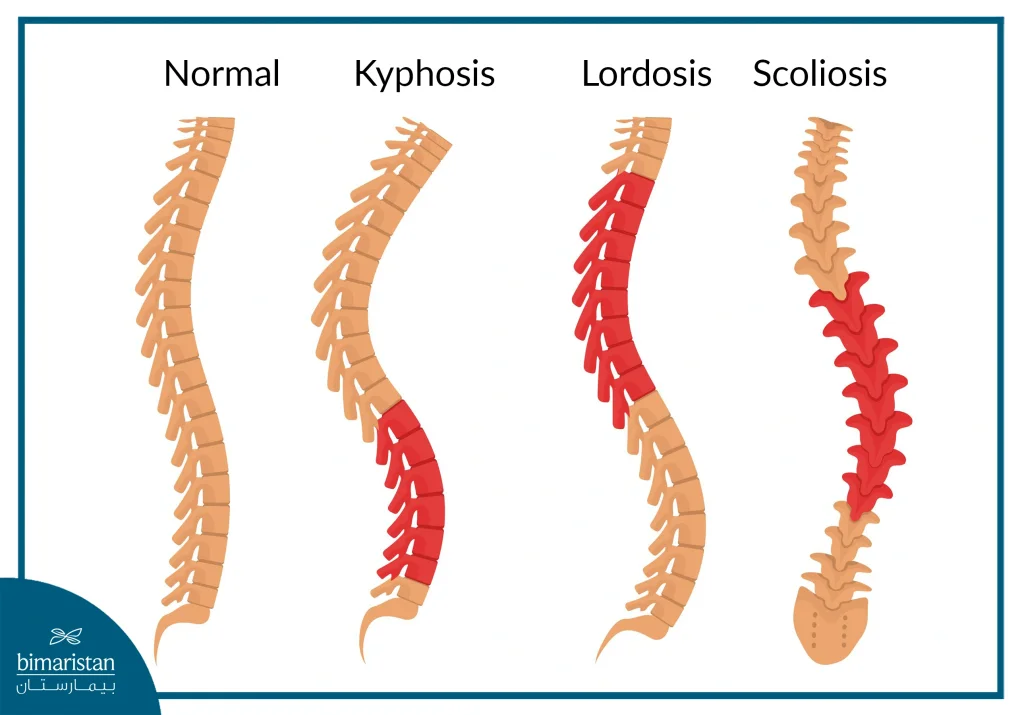 Differences Between Different Spinal Deformities