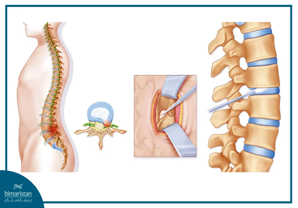 Endoscopic Disc Treatment Is One Of The Latest Treatment Methods