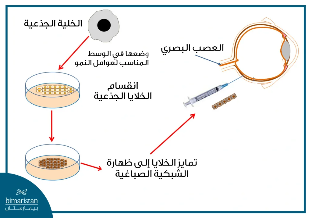 علاج العمى الوراثي بالخلايا الجذعية