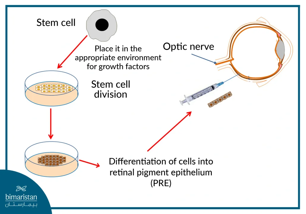 Hereditary Blindness Treatment With Stem Cell