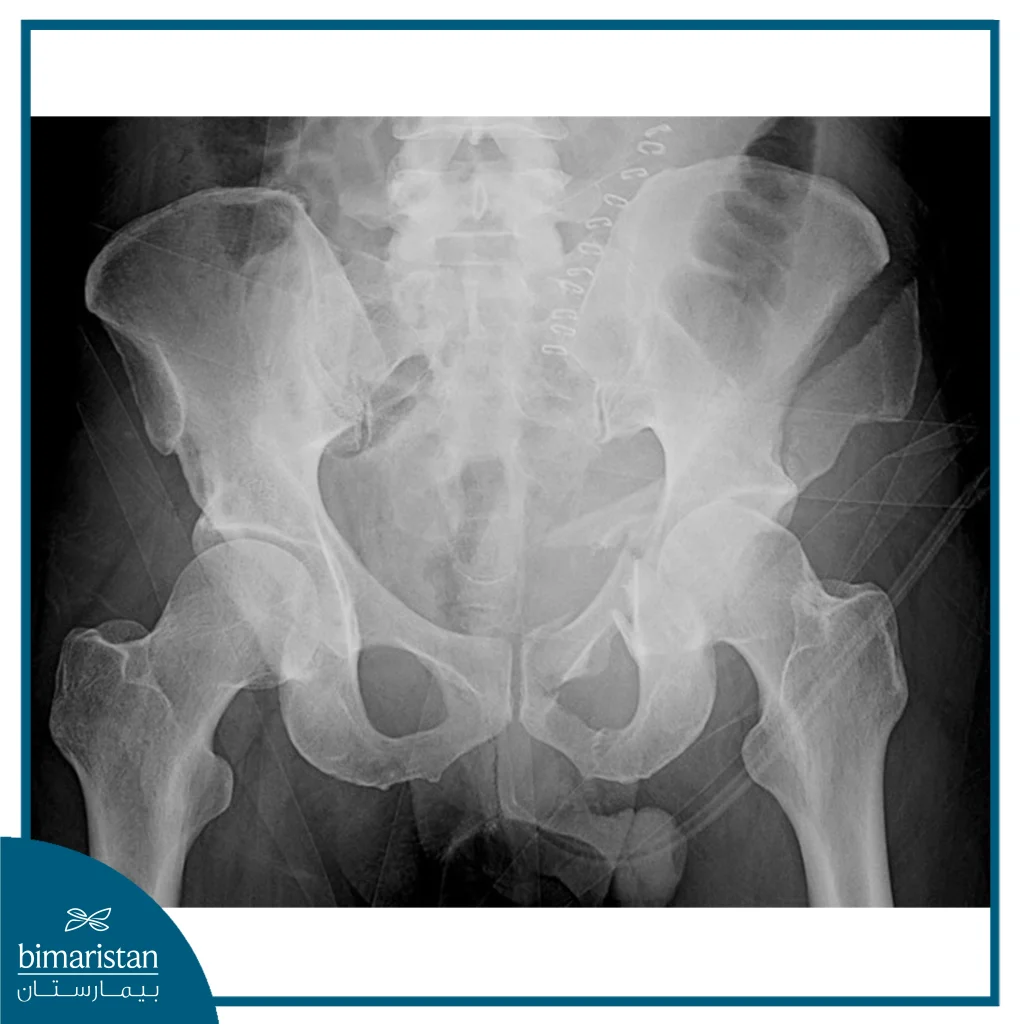 Image Of A Broken Pelvis With Arrows Indicating The Location Of The Fractures.