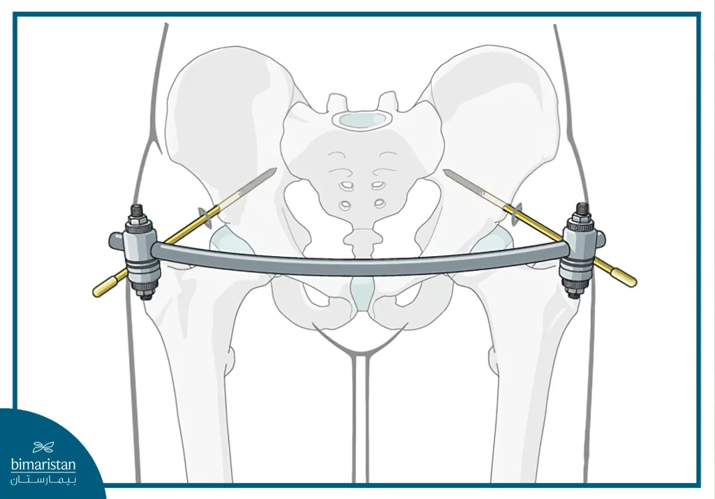 External Fixation For Pelvic Fracture Treatment