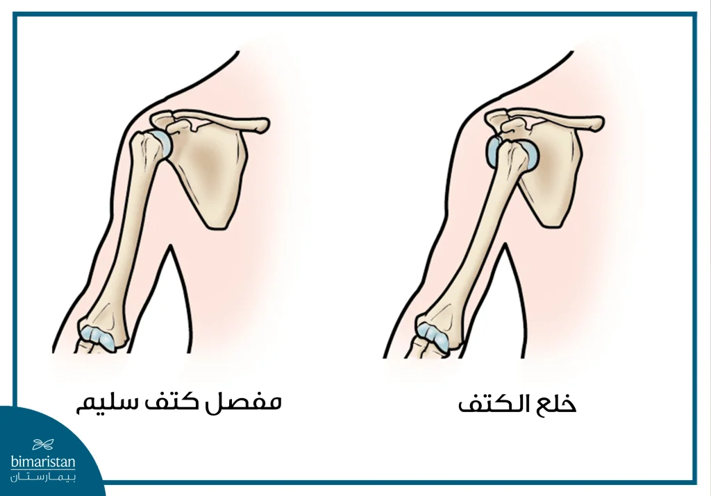 لاحظ خلع مفصل الكتف بالمقارنة مع الحالة الطبيعية للمفصل