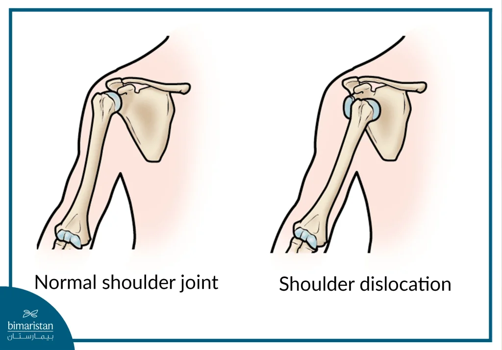 Note The Dislocation Of The Shoulder Joint Compared To The Normal Condition Of The Joint.