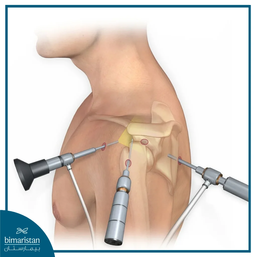 Arthroscopic Shoulder Dislocation Surgery