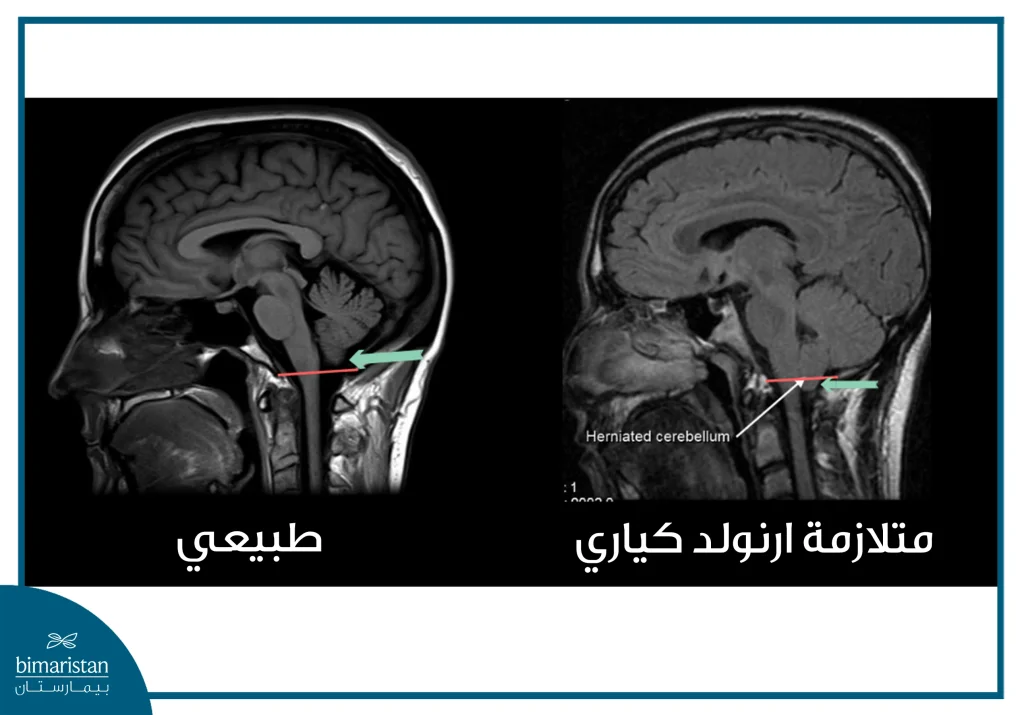 صورة رنين مغناطيسي توضح انقتاق المخيخ عبر الثقبة الكبيرة في سياق متلازمة ارنولد كياري