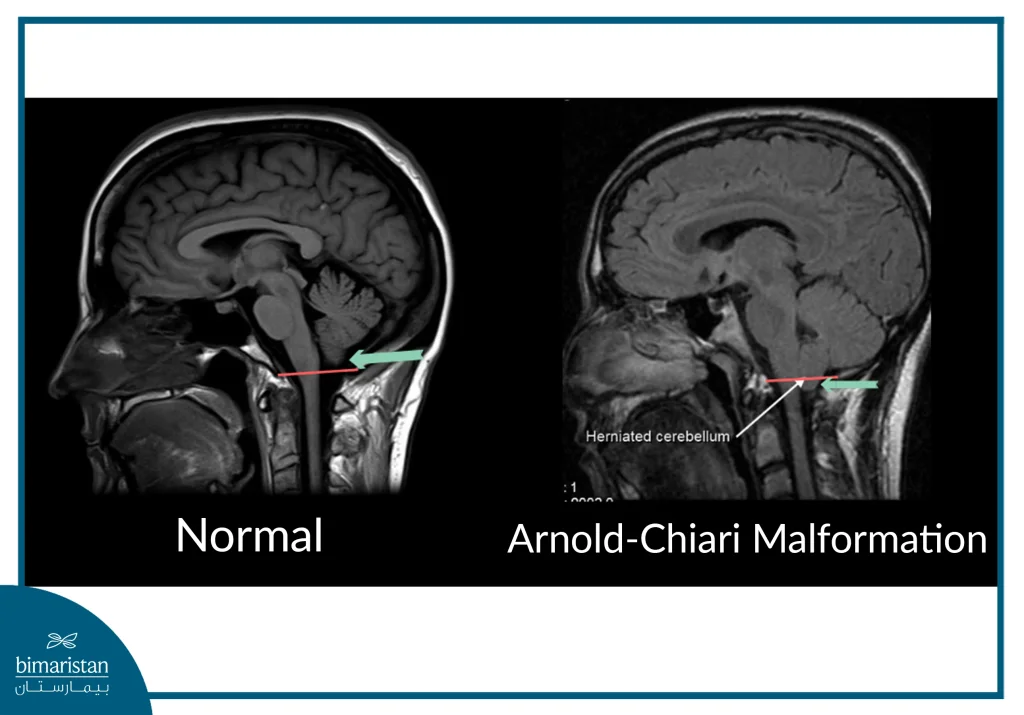 Mri Showing Cerebellar Herniation Through The Foramen Magnum In The Context Of Arnold-Chiari Malformation