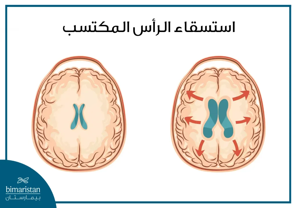 استسقاء الرأس المكتسب والذي يحصل بعد الولادة نتيجة أسباب مختلفة تمنع تصريف السائل الدماغي الشوكي