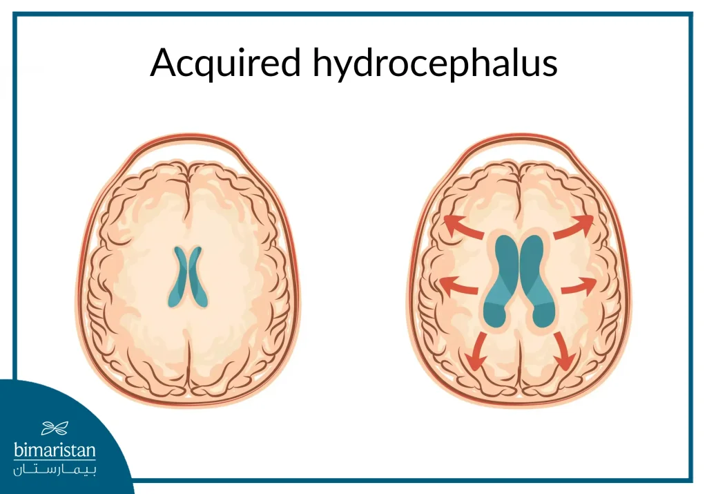 Acquired Hydrocephalus, Which Occurs After Birth As A Result Of Various Causes That Prevent The Drainage Of Cerebrospinal Fluid