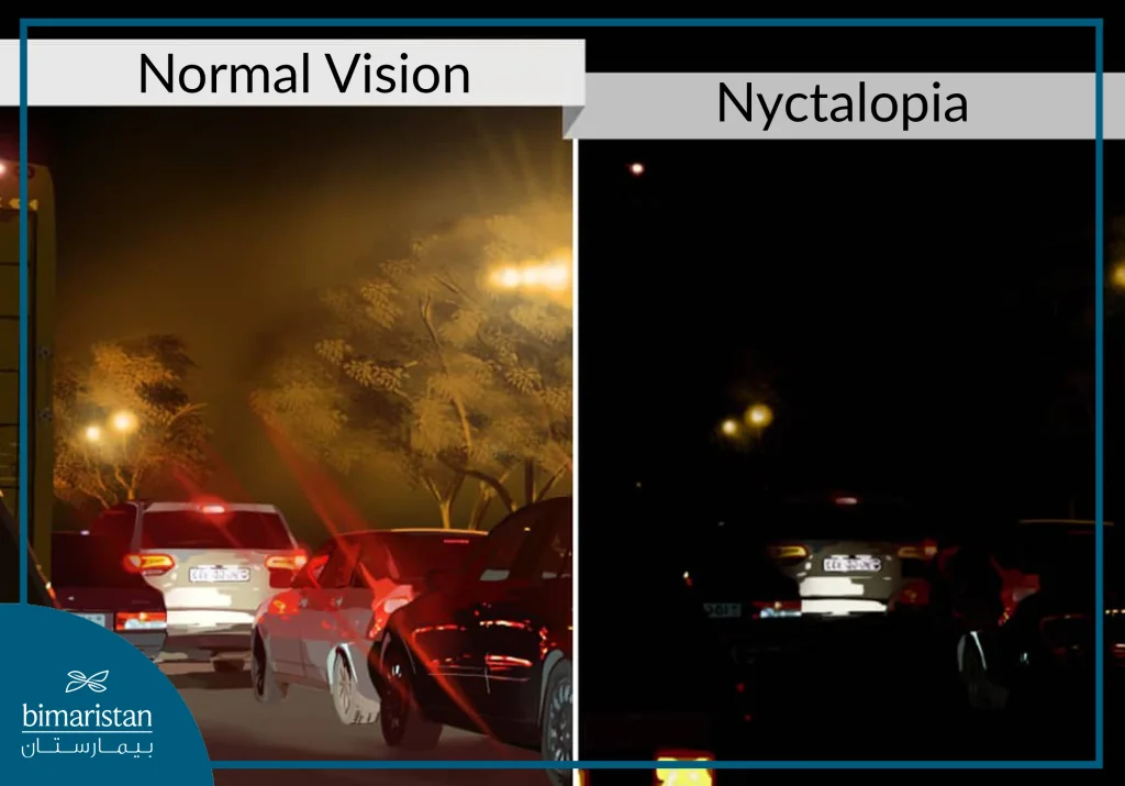 People With Nyctalopia Should Not Drive At Night