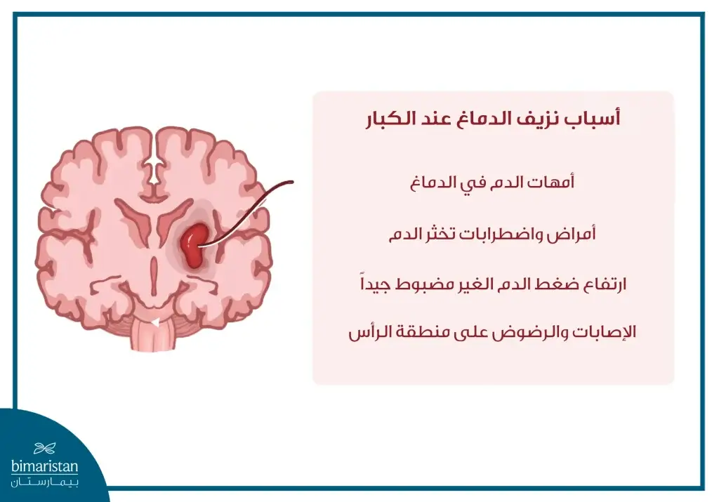 صورة لأهم أسباب نزيف الدماغ عند الكبار كارتفاع الضغط الدموي الغير مضبوط وتمدد الأوعية الدموية