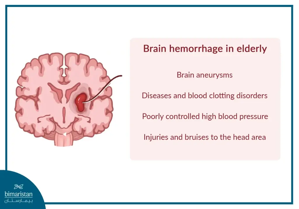 Image Of The Most Important Causes Of Brain Hemorrhage In Adults, Such As Uncontrolled High Blood Pressure And Aneurysms