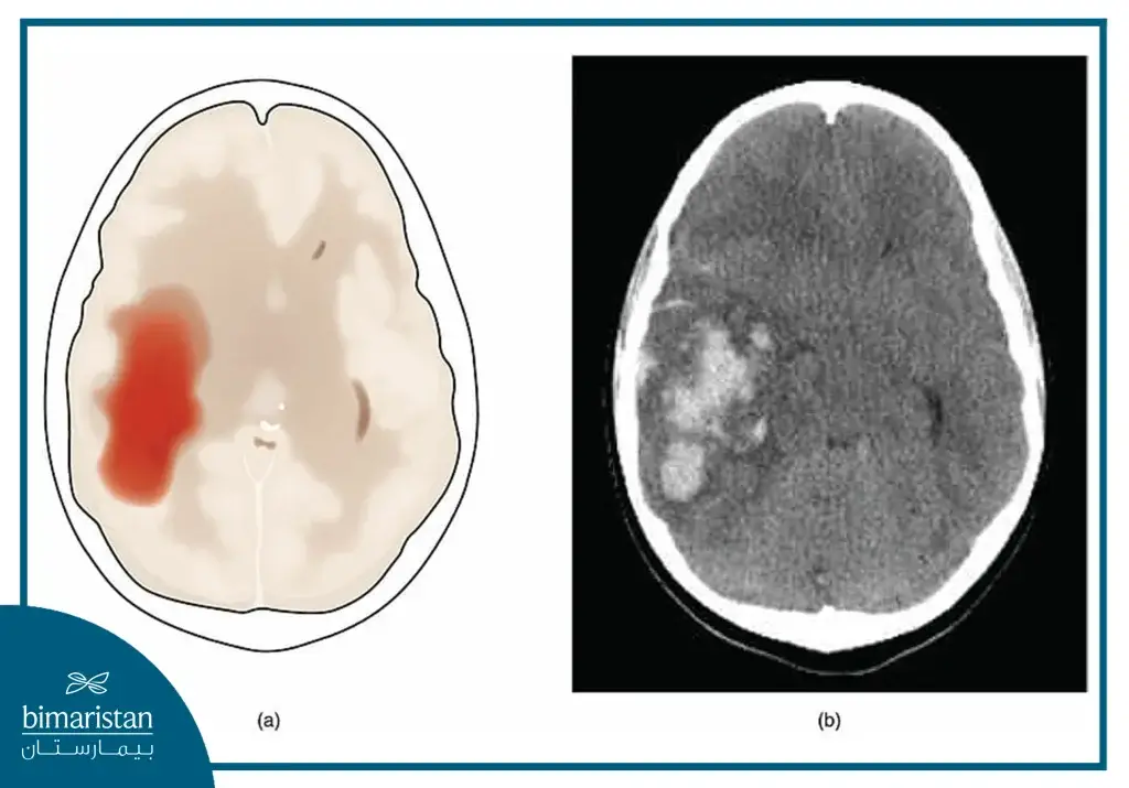 Ct Scan Of A Brain Hemorrhage In Elderly