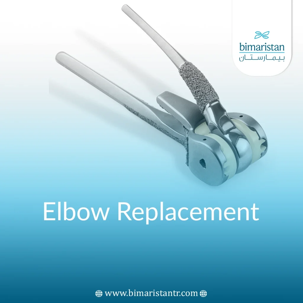 Elbow Replacement Surgery In Turkey