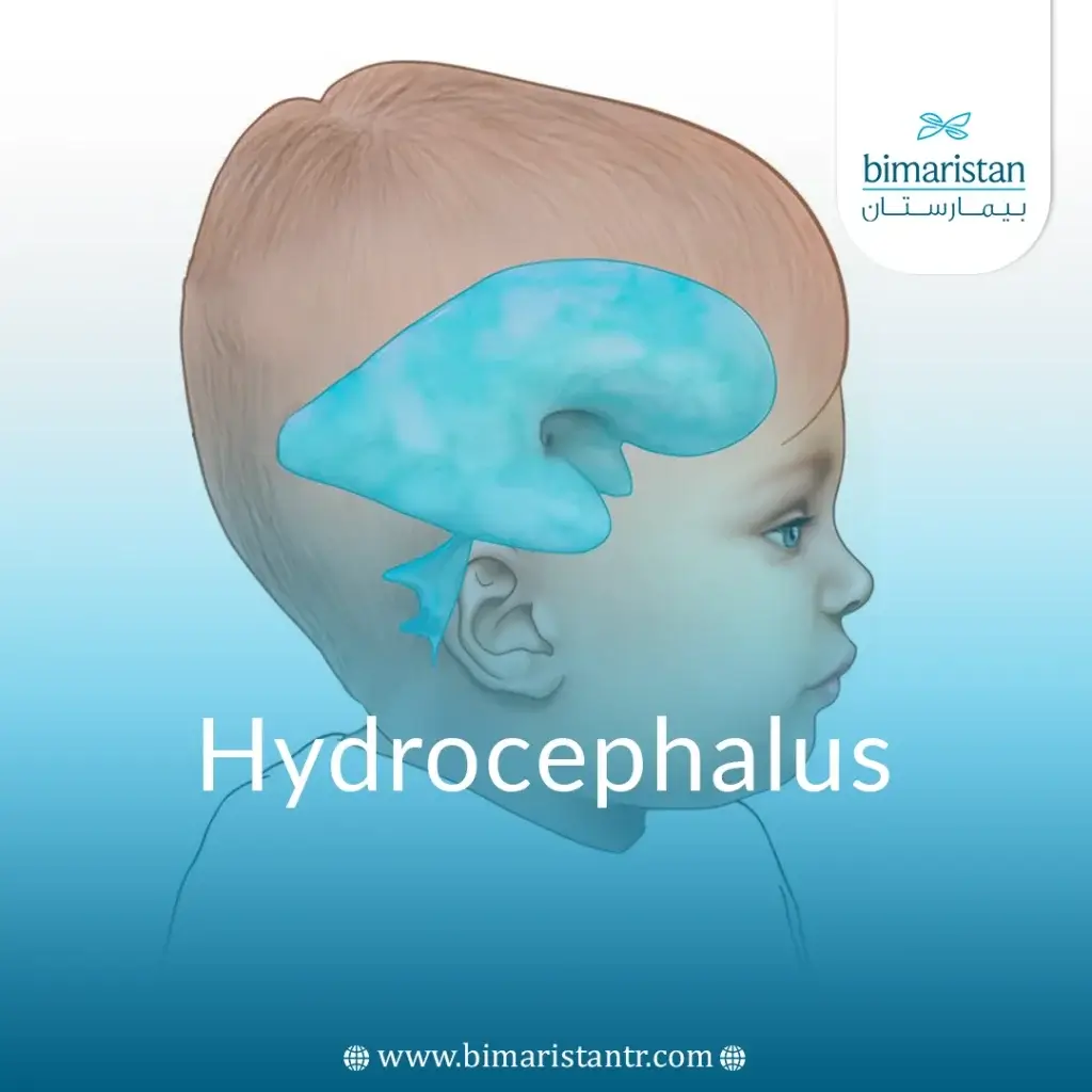 Hydrocephalus (Water On The Brain) Treatment In Turkey