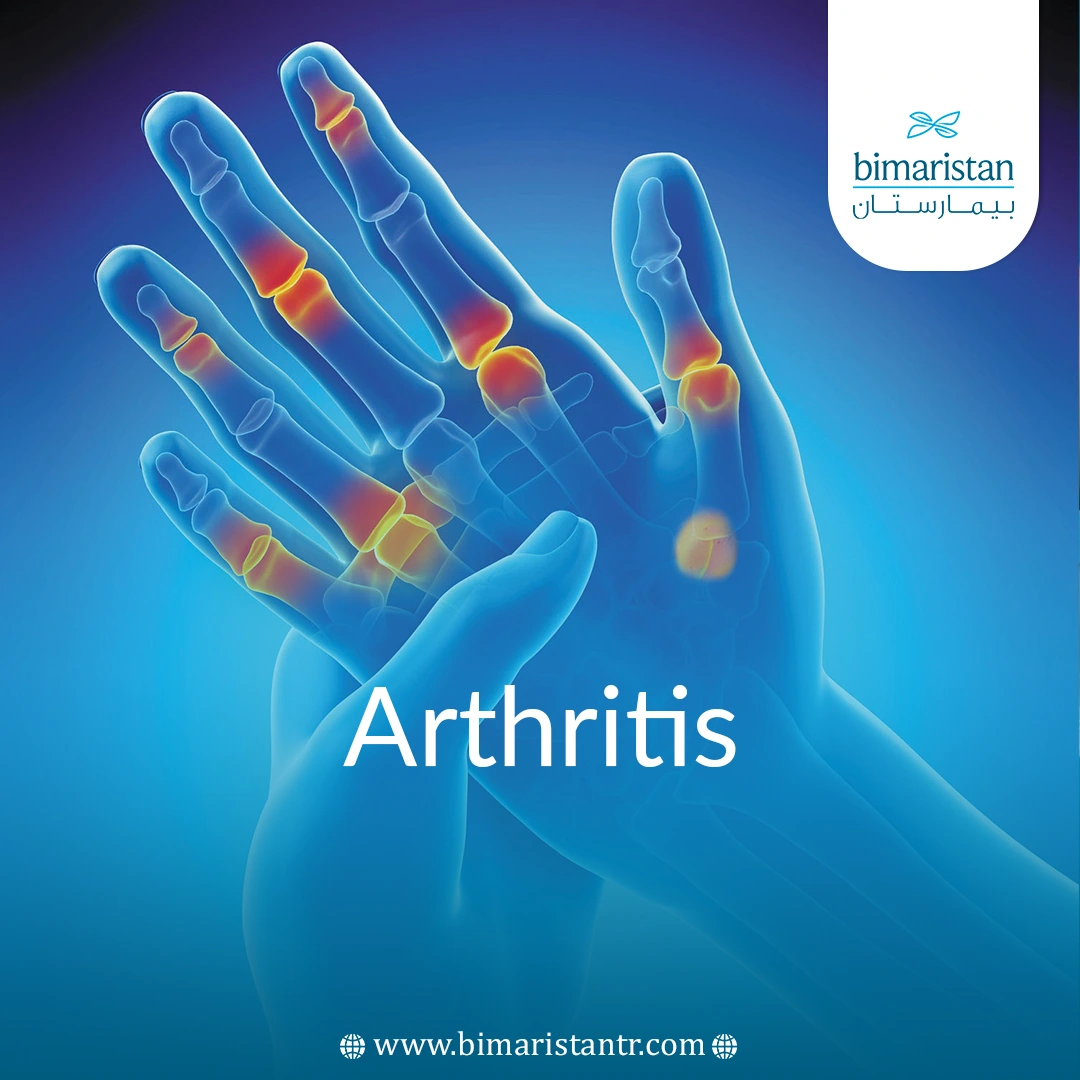 Arthritis Diagnosis, Causes And Treatments