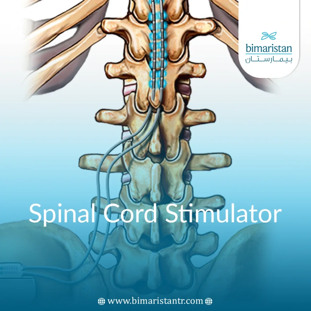 Spinal Cord Stimulator For Chronic Pain In Turkey