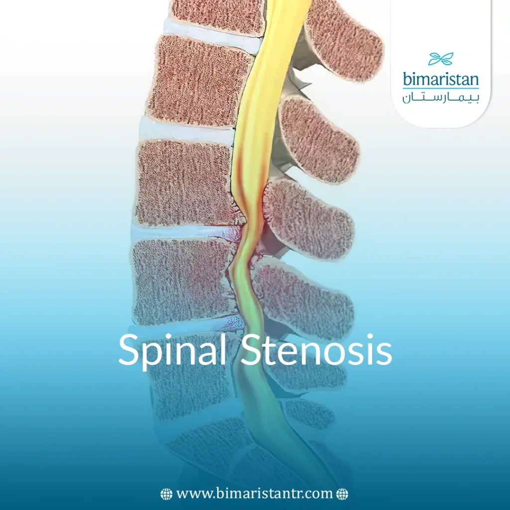 Spinal Stenosis Causes, Symptoms, And Treatment In Turkey