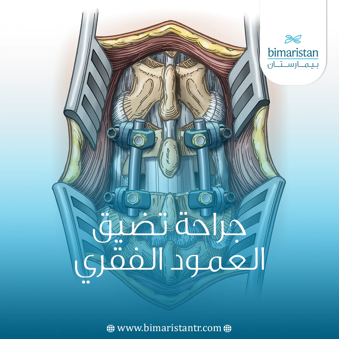 جراحة تضيق العمود الفقري أو القناة الشوكية في تركيا