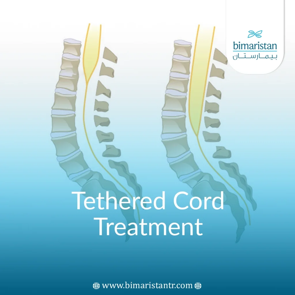 Tethered Cord Treatment In Turkey