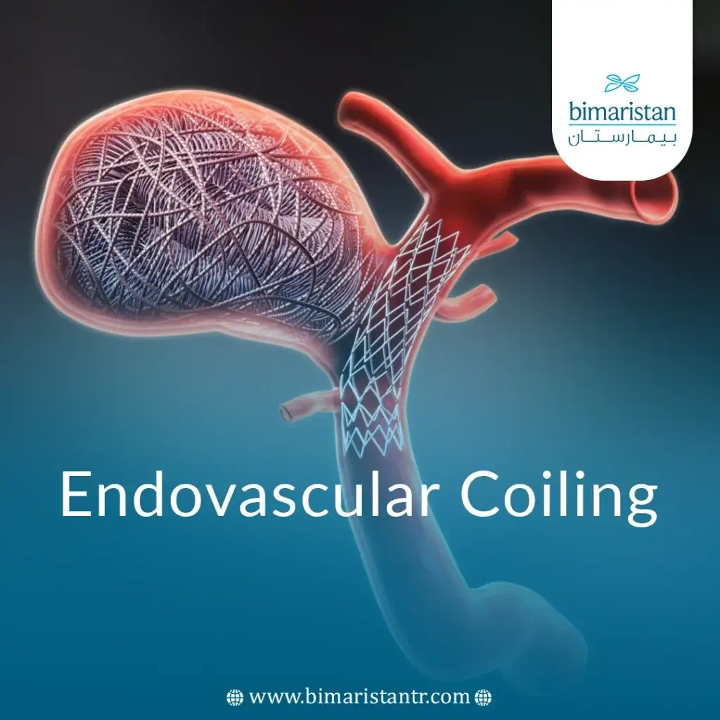 Endovascular Coiling