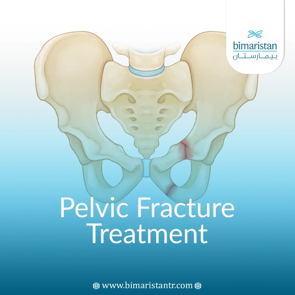 Pelvic Fracture Treatment