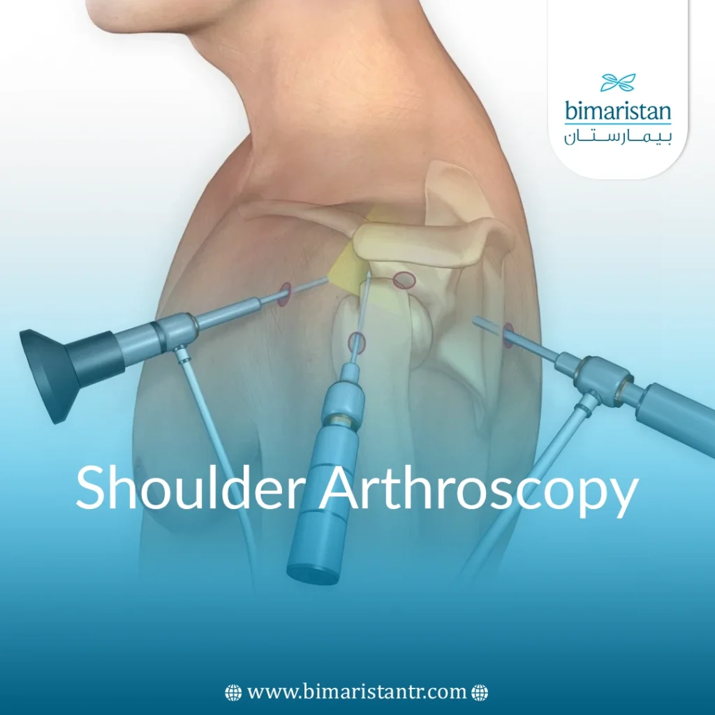 Shoulder Arthroscopy Surgery In Turkey