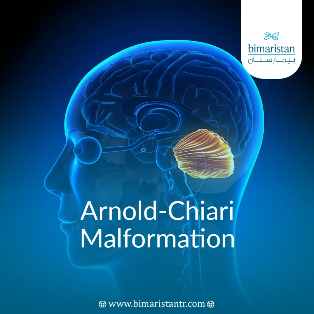 Mri Showing Cerebellar Herniation Through The Foramen Magnum In The Context Of Arnold-Chiari Malformation