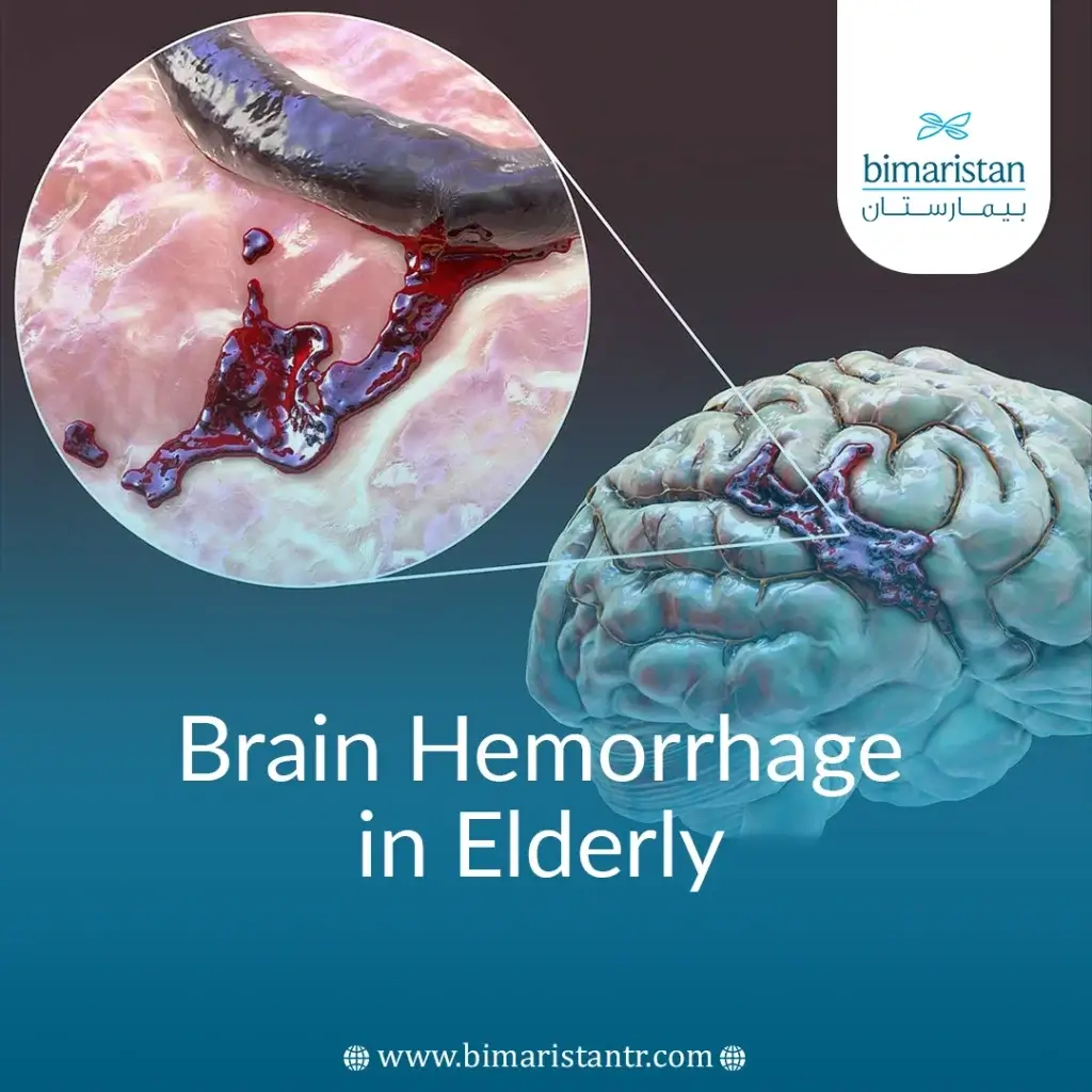 Brain Hemorrhage In Elderly