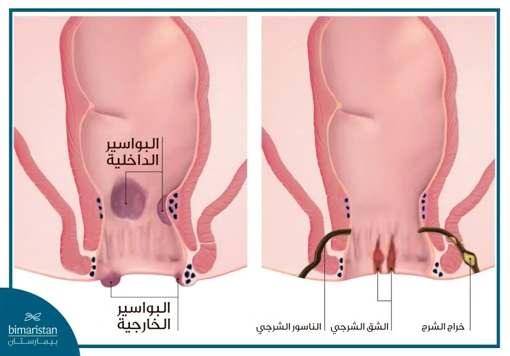 الفرق بين الناسور الشرجي والباسور الشرجي بالصور