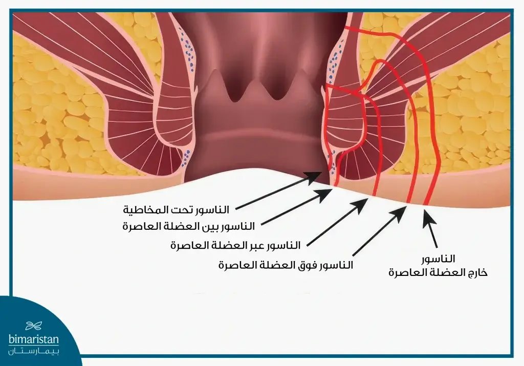 أنواع الناسور الشرجي