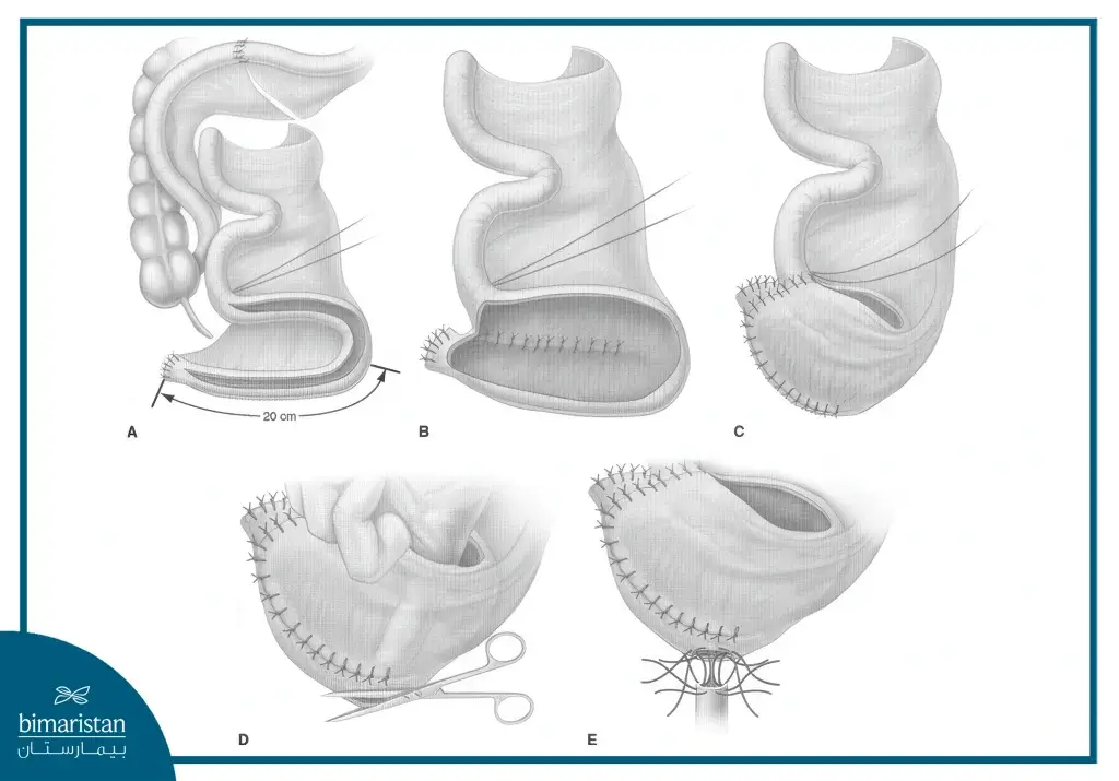 Image About How To Perform The Neobladder Surgery