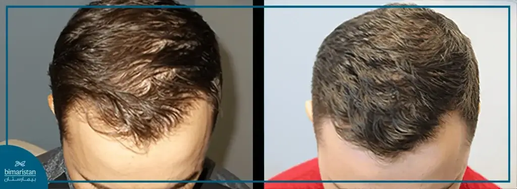 Image Showing The Difference Before And After Plasma Injection For Hair After Transplantation