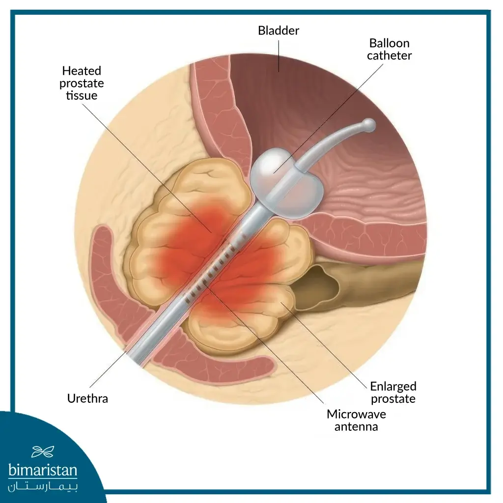 Trans-Urethral Microwave Thermal Prostate Treatment (Tumt)