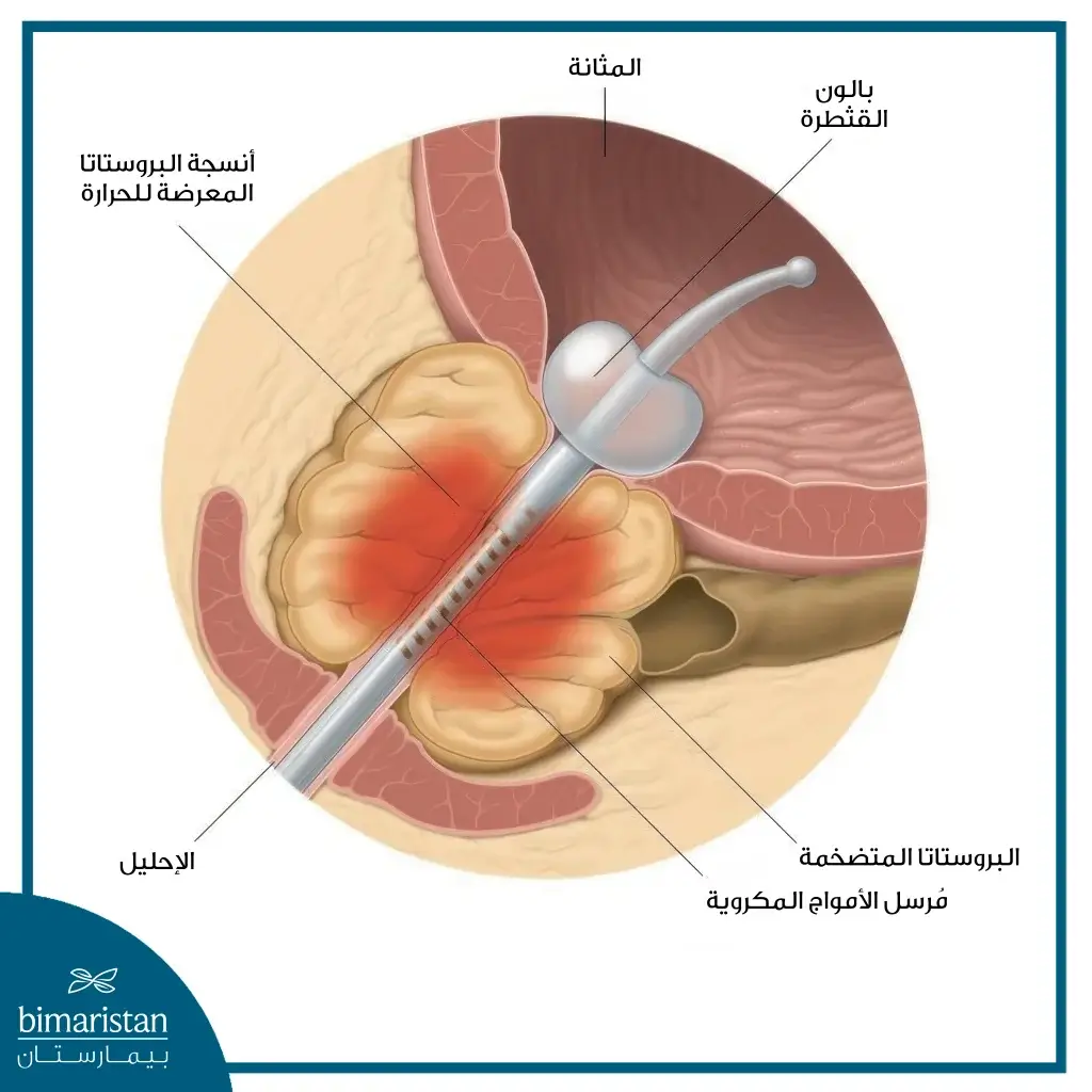 علاج البروستاتا الحراري بالموجات الدقيقة عبر الإحليل (Tumt)