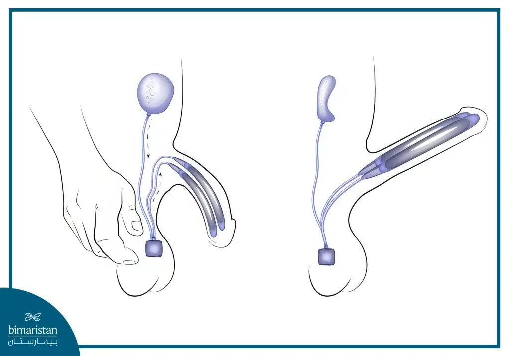 What Is Penile Implant Surgery?