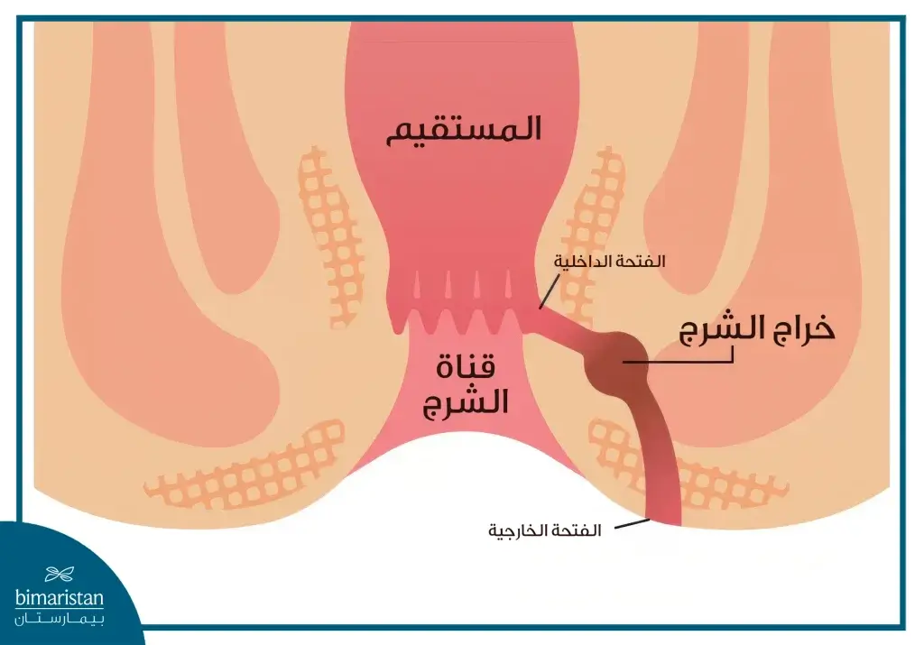 شكل الناسور الشرجي بالصور