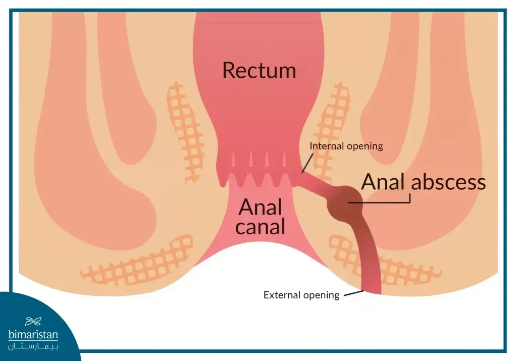 What Does An Anal Fistula Look Like?