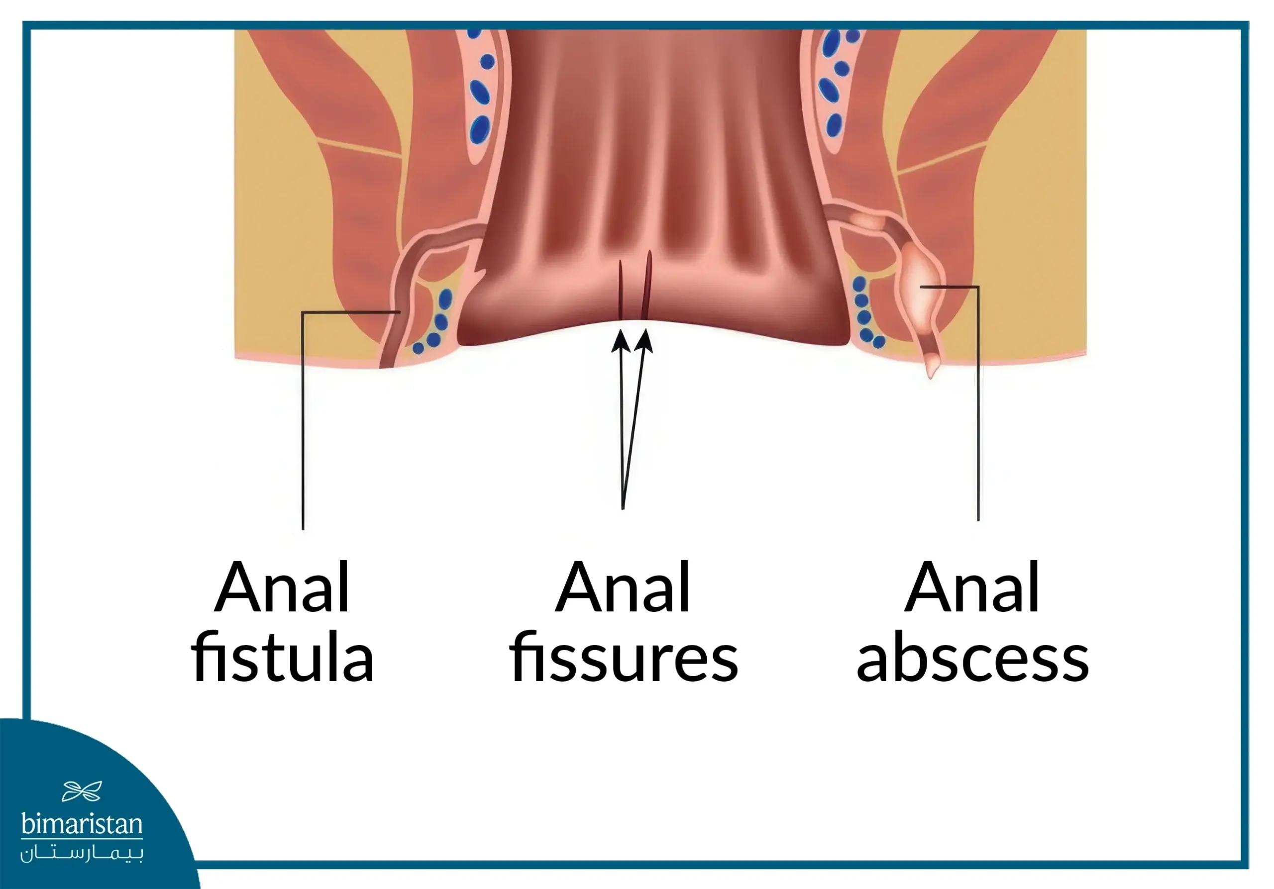 The Difference Between Anal Fistula And Anal Fissure