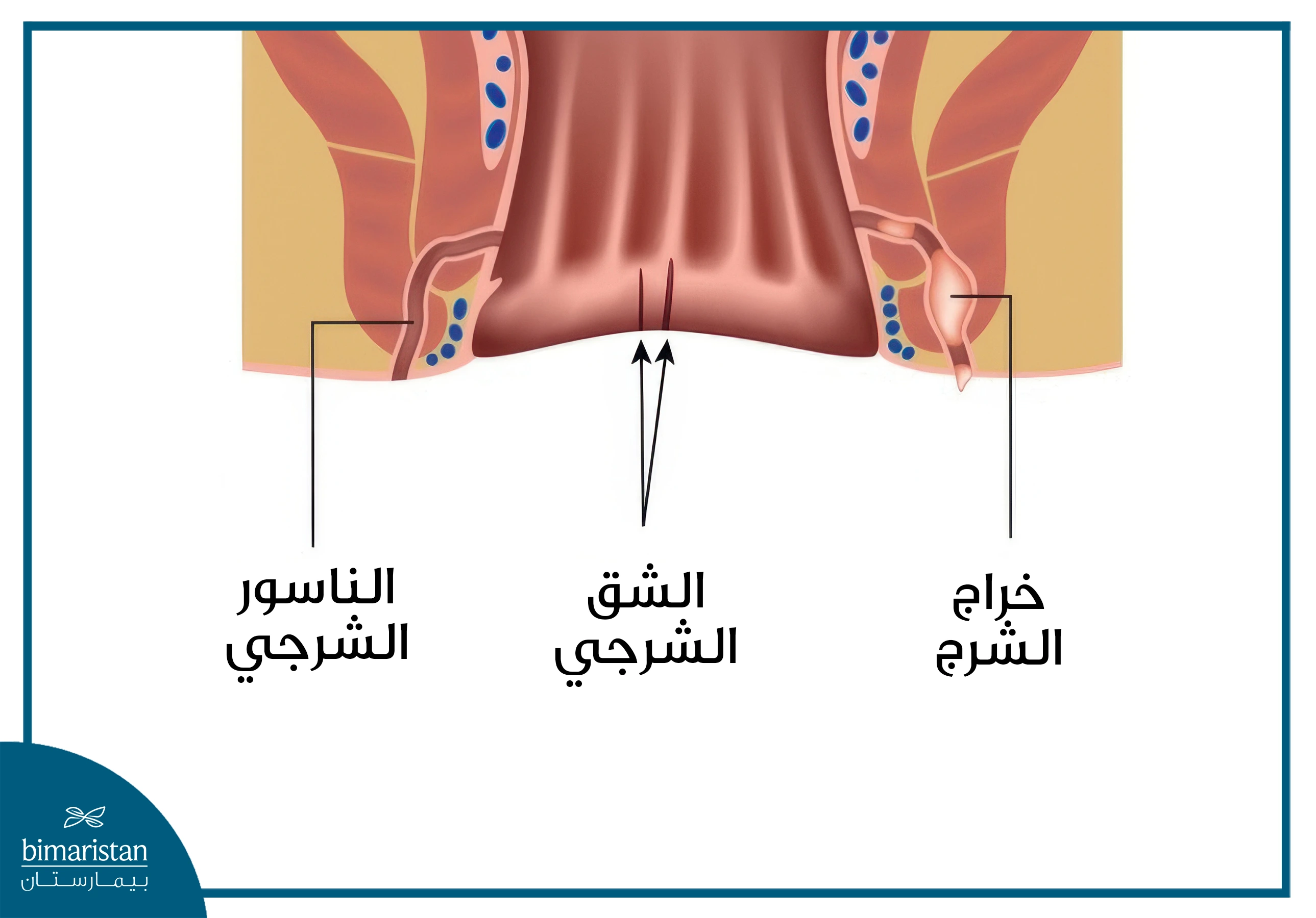 الفرق بين الناسور الشرجي والشق الشرجي بالصور