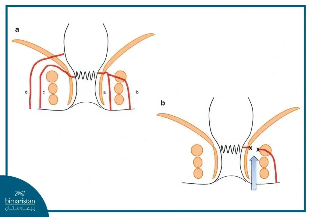 Lift Procedure Is A Surgical Anal Fistula Treatment