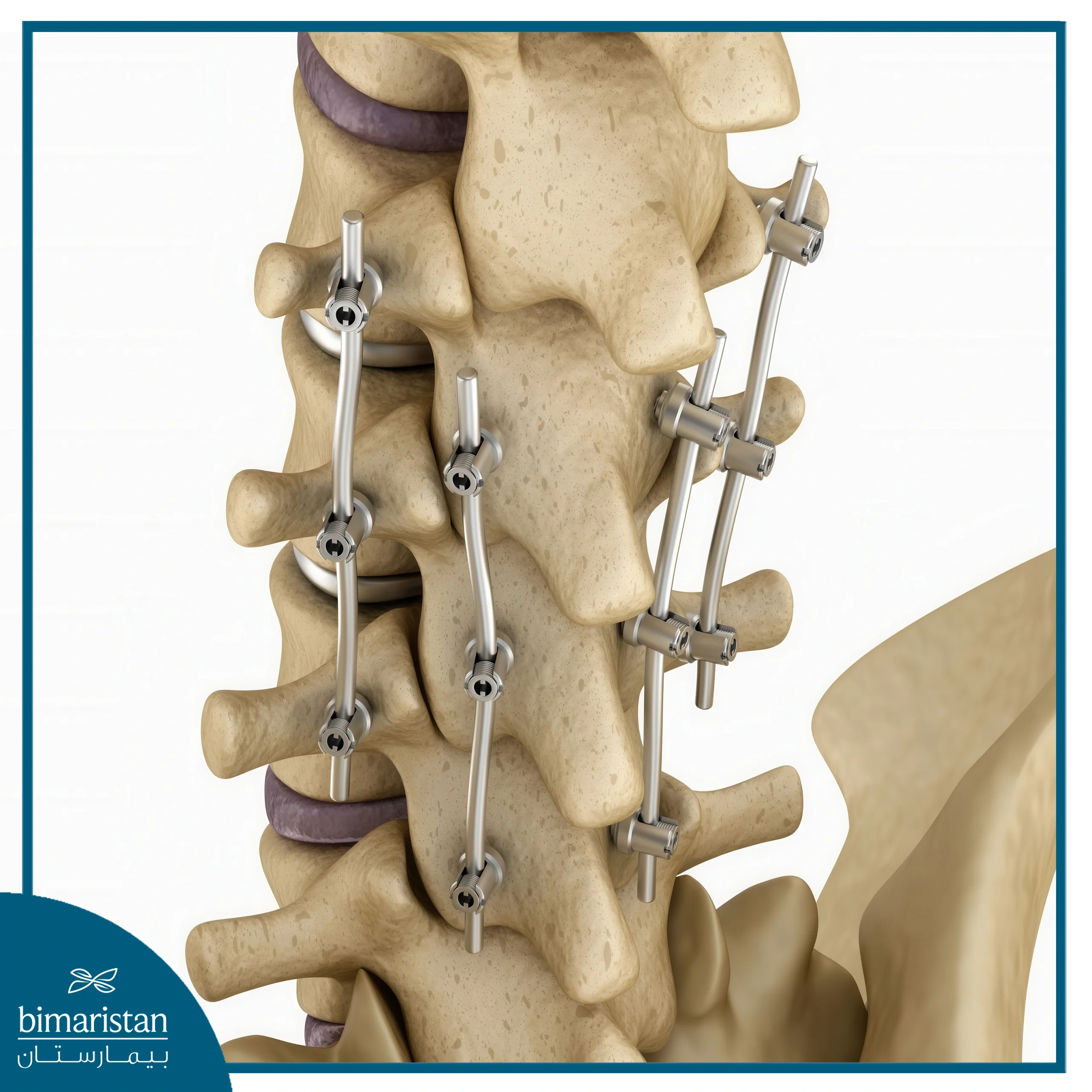 Kyphosis Treatment: A Revolutionary Solution For Hunchback Treatment 6 Spinal Fusion Surgery To Treat Kyphosis