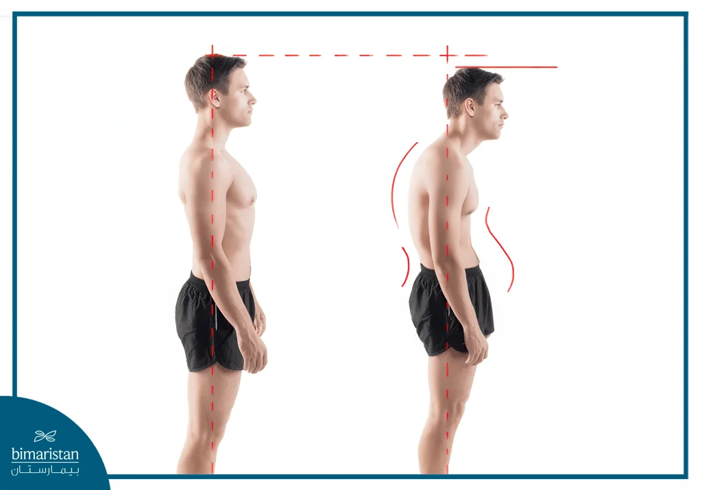 Kyphosis Treatment: A Revolutionary Solution For Hunchback Treatment 5 What Is Kyphosis?