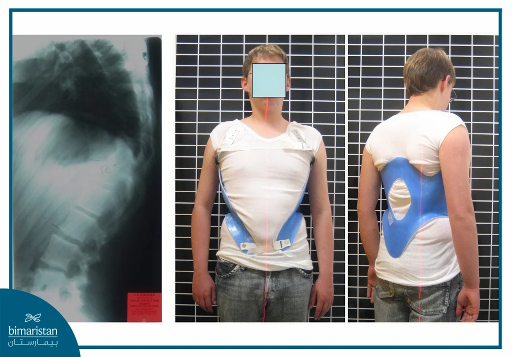 Kyphosis Treatment: A Revolutionary Solution For Hunchback Treatment 7 Bracing For Scheuermann'S Kyphosis