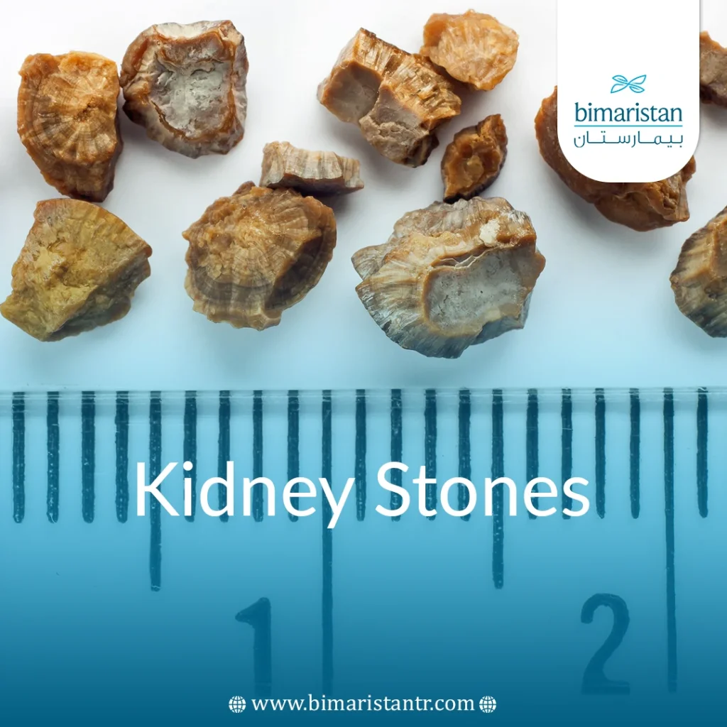 can smoking cigarettes cause kidney stones Kidney Stones Causes, symptoms & Treatment in Turkey can smoking cigarettes cause kidney stones Kidney Stones Causes, symptoms & Treatment in Turkey